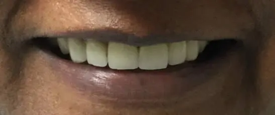 A photo of smile after