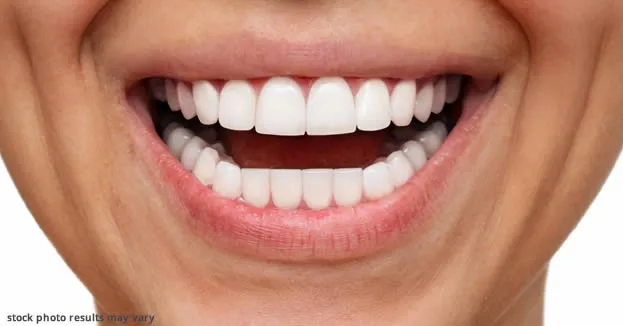 Teeth after porcelain veneers treatment at B Well Dental Studio
