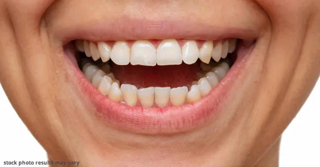 Teeth before porcelain veneers treatment